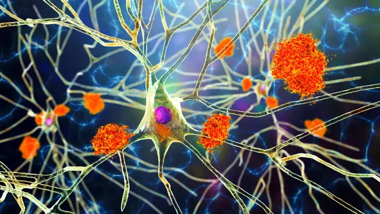 Alzheimer’s Startup Secures $175M Funding Boost to Accelerate Innovative Treatments