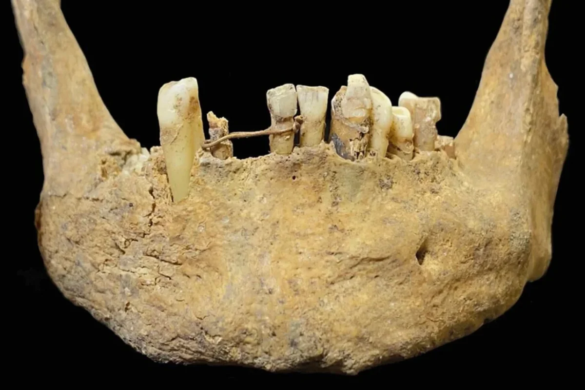 Medieval Scottish Grave Reveals Rare Gold Dental Bridge, Challenging Historical Perceptions
